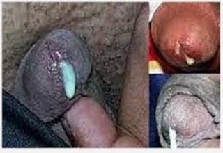 Obat kencing nanah yang paling ampuh, obat injeksi kencing nanah, gejala penyakit gonore adalah, obat gonore (kemaluan keluar nanah) apa, tanda kencing nanah pada wanita, obat alami untuk gonore (kencing nanah), obat khusus gonore (kencing nanah), mengobati kemaluan bernanah, terapi sifilis, obat penyakit gonore alami, penyakit sipilis raja singa