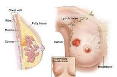 Cara mengobati kanker payudara tanpa operasi, kanker payudara dan obat herbalnya, bagaimana gejala awal kanker payudara, obat utuk kanker payudara, pengobatan alternatif kanker payudara di bandung, kejadian kanker payudara di indonesia, cara jitu mengobati kanker payudara, mengobati kanker payudara kakaknya, ramuan tradisional mengobati kanker payudara, penyebab kanker payudara pada pria, obat kanker payudara stadium 1